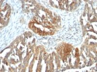 FFPE human ovarian carcinoma sections stained with 100 ul anti-VEGF (clone VEGF/1063) at 1:50. HIER epitope retrieval prior to staining was performed in 10mM Tris 1mM EDTA, pH 9.0.